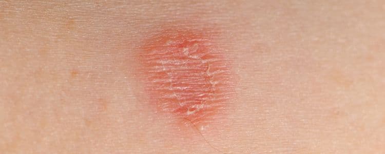 Ringworm Relief: The Ultimate Guide to Homeopathic Solutions