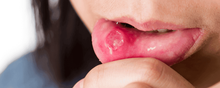 Ulcers on Mouth and Lips Causes, Risk Factors, and Remedies